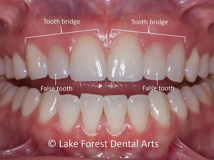 How To Clean Bridge Teeth?