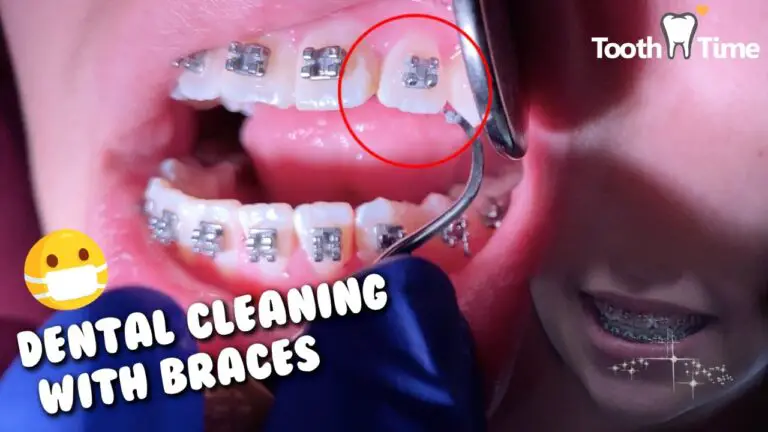 Can Dentist Clean Teeth With Braces?