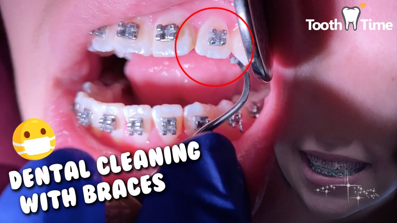 Can Dentist Clean Teeth With Braces?